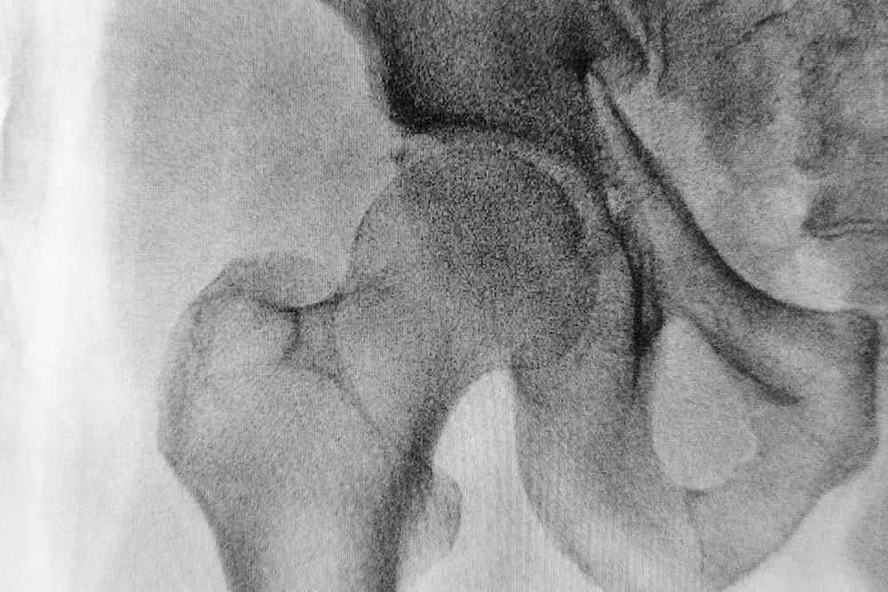 脊医能否帮助骨关节炎不适？